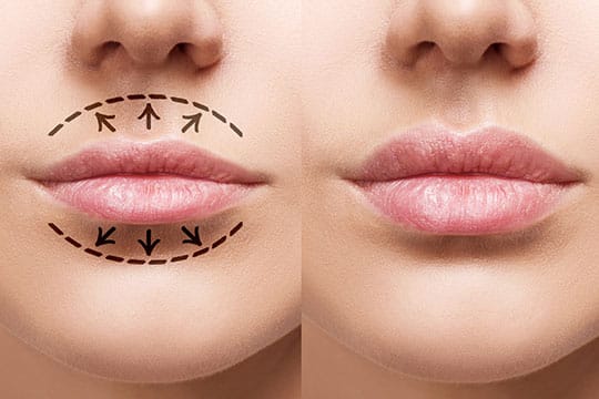 Hyaluron Wirkung Bereiche Lippenkorrektur
