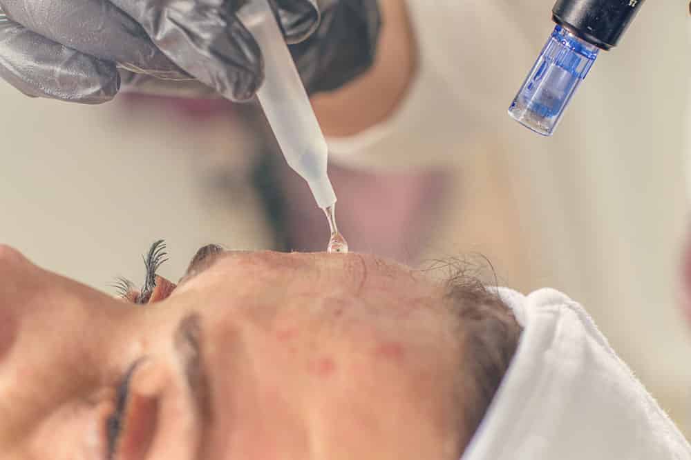 Kompositorische Ästhetik - Fadenlifting & Needling 1