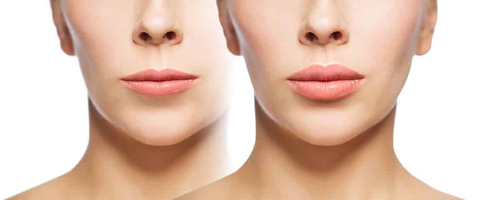 Kompositorische Ästhetik - Mesotherapie mit PRP 2